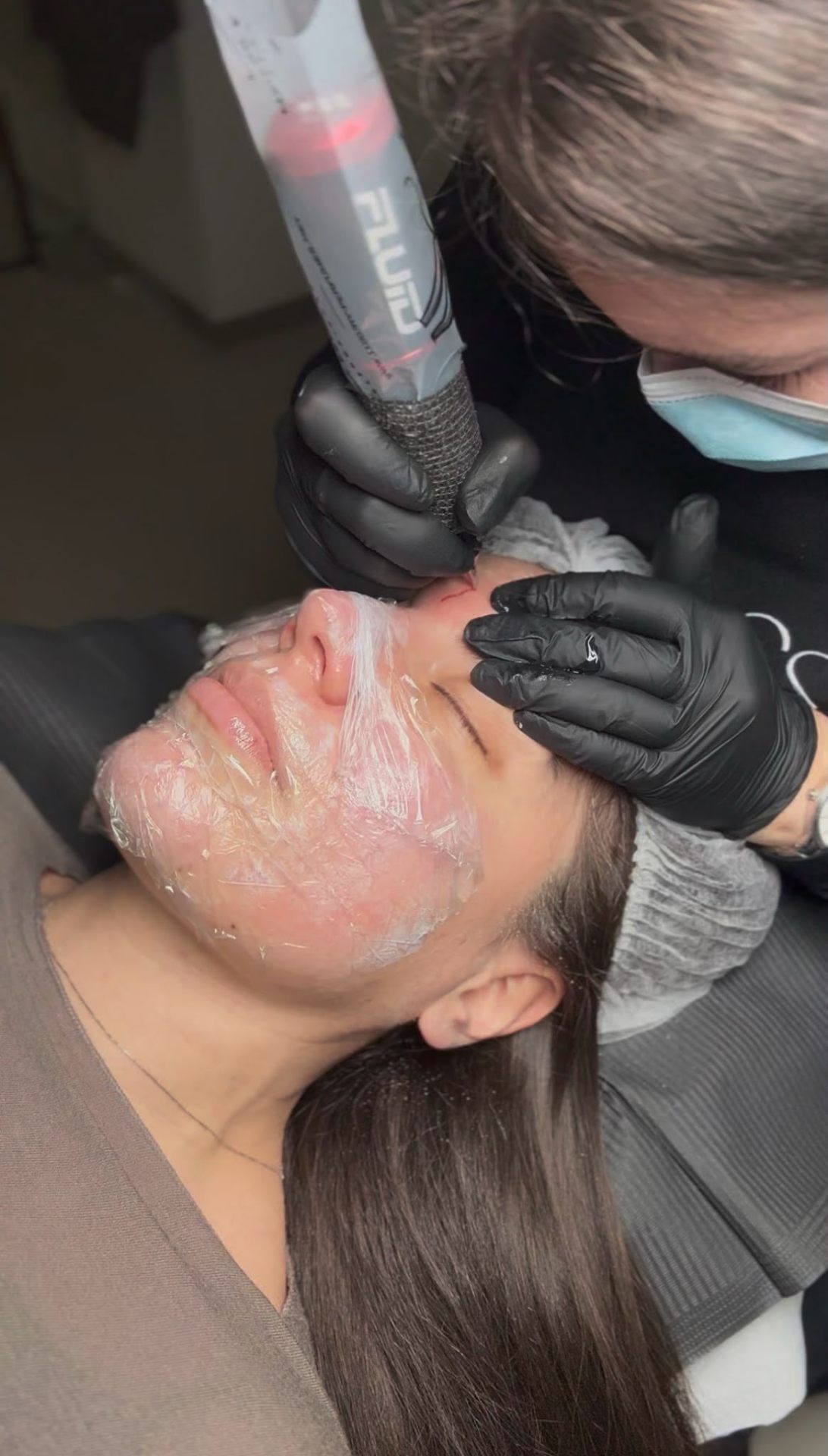 Needling